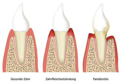 Parodontitis-Behandlung