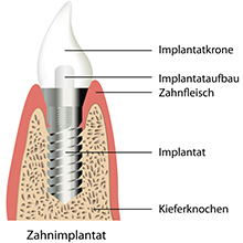 Zahnimplantat